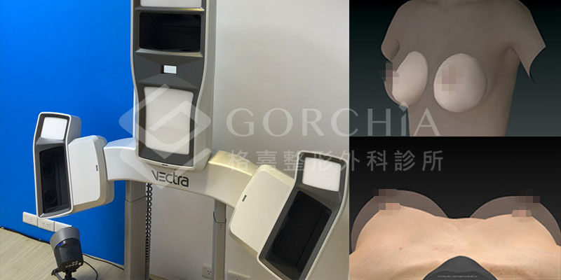 【隆乳案例 】隆乳手術當天-內視鏡隆乳-Vectra 3D 模擬
