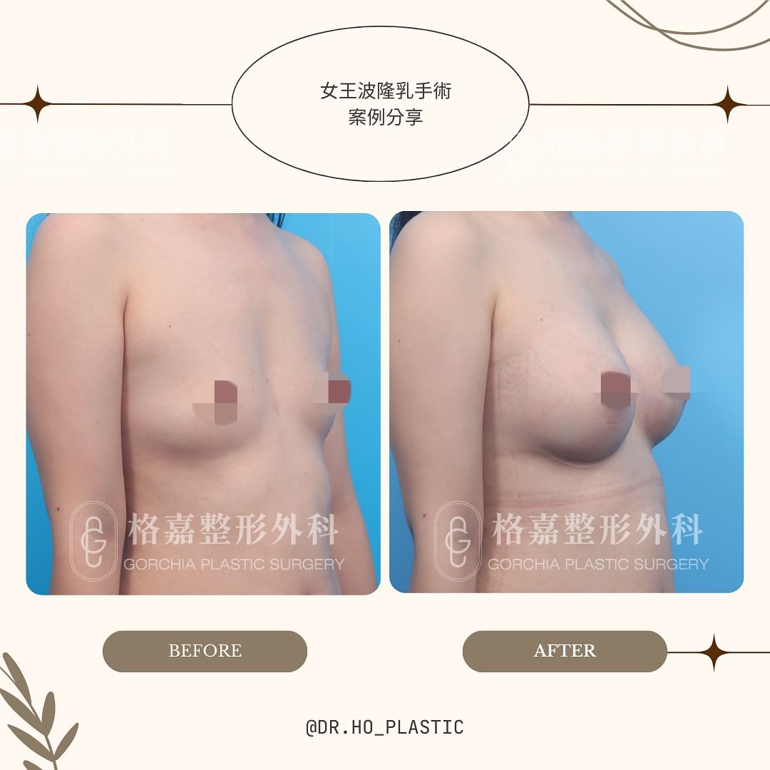 台中隆乳推薦丨格嘉何格彰內視鏡隆乳成功案例