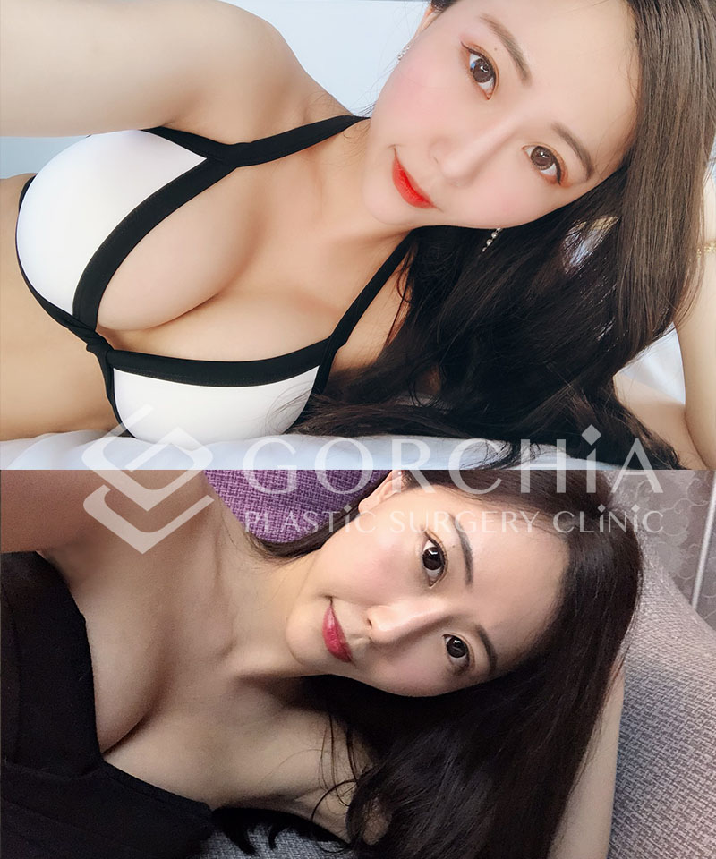 台中隆乳推薦魔滴隆乳案例