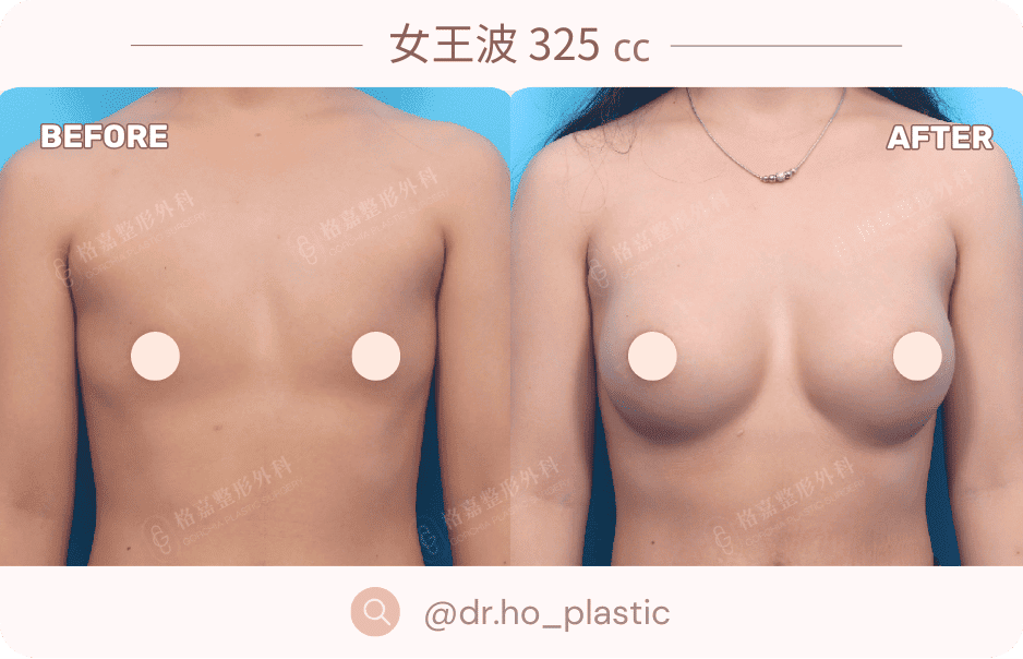 女王波隆乳案例1